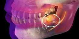 智齒拔除之後有牙洞該怎麼辦？又該注意哪些事項？